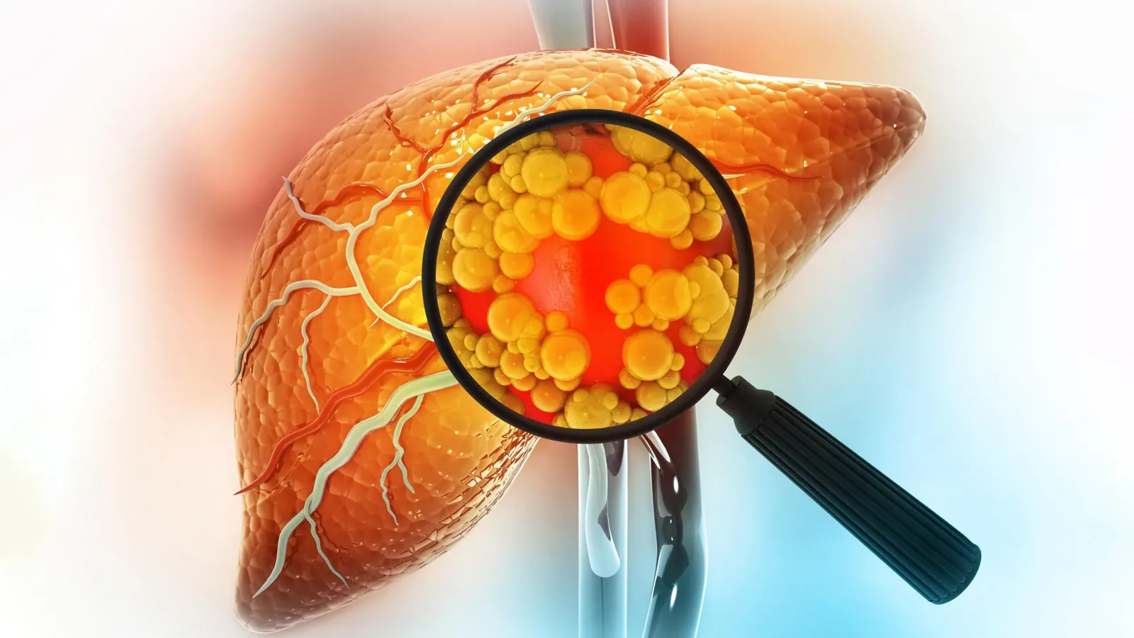 MIT Research: High-Fat Diets Prime Liver for Cancer